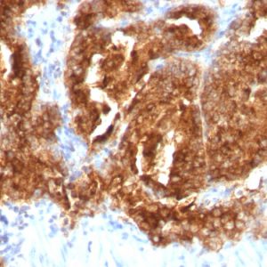 Formalin-fixed, paraffin-embedded human Prostate Carcinoma stained with TAG-72 Mouse Monoclonal Antibody (CA72/733).