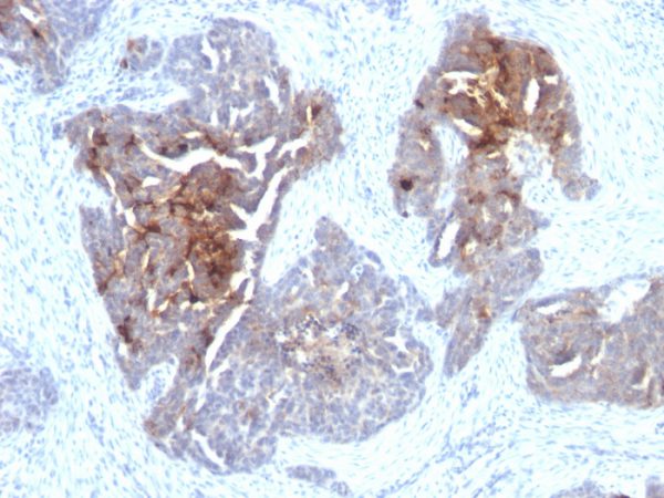 Formalin-fixed, paraffin-embedded human Ovarian Carcinoma stained with TAG-72 Mouse Monoclonal Antibody (CA72/733).