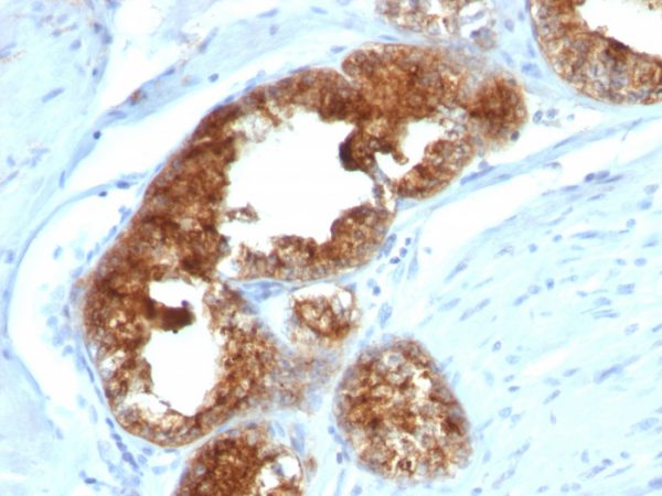 Formalin-fixed, paraffin-embedded human Prostate Carcinoma stained with TAG-72 Monoclonal Antibody (B72.3 + CA72/733).