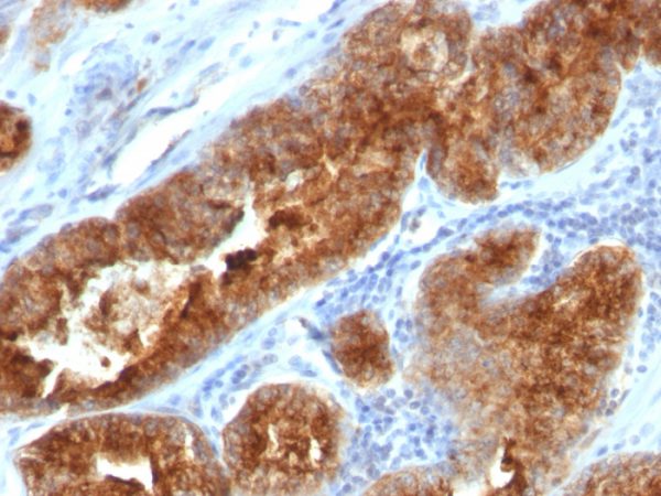 Formalin-fixed, paraffin-embedded human Prostate Carcinoma stained with TAG-72 Monoclonal Antibody (B72.3 + CC49).