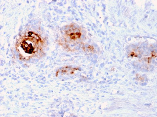 Formalin-fixed, paraffin-embedded human Breast Carcinoma stained with TAG-72 Recombinant Mouse Monoclonal Antibody (rB72.3).