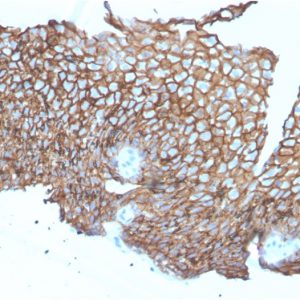 Formalin-fixed, paraffin-embedded human Esophageal Carcinoma stained with Desmoglein-3 Mouse Monoclonal Antibody (DSG3/2840).