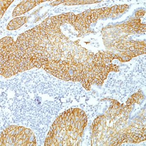 Formalin-fixed, paraffin-embedded human Lung Squamous Cell Carcinoma stained with Desmoglein-3 Monoclonal Antibody (DSG3/1535).