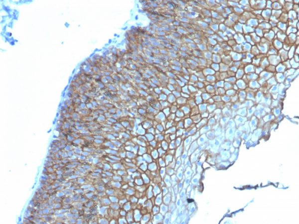 Formalin-fixed, paraffin-embedded human Esophageal Carcinoma stained with Desmoglein-3 Mouse Monoclonal Antibody (DSG3/2839).