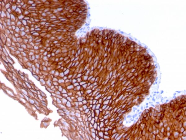 Formalin-fixed, paraffin-embedded human Esophageal Carcinoma stained with Desmoglein-3 Mouse Monoclonal Antibody (DSG3/2839).