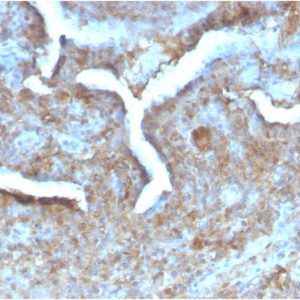 Formalin-fixed, paraffin-embedded human Prostate Carcinoma stained with Thymidine Phosphorylase Rabbit Recombinant Monoclonal (TYMP/2890R).
