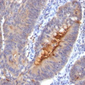 Formalin-fixed, paraffin-embedded human colon carcinoma stained with Secretory Component Mouse Monoclonal Antibody (SC-05).