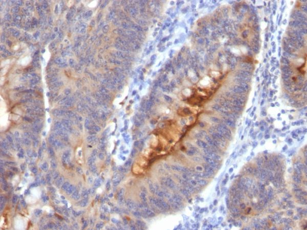 Formalin-fixed, paraffin-embedded human colon carcinoma stained with Secretory Component Mouse Monoclonal Antibody (SC-05).