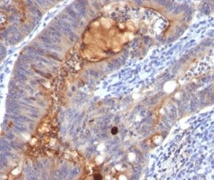 Formalin-fixed, paraffin-embedded human colon carcinoma stained with Secretory Component Mouse Monoclonal Antibody (SPM217).