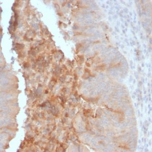 Formalin-fixed, paraffin-embedded human Colon Carcinoma stained with IgA Secretory Component Mouse Monoclonal Antibody (ECM1/792).