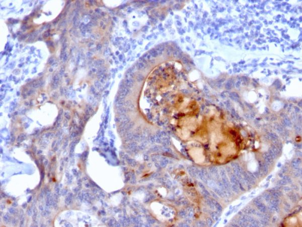 Formalin-fixed, paraffin-embedded human Colon Carcinoma stained with IgA Secretory Component Mouse Monoclonal Antibody (rECM1/792).