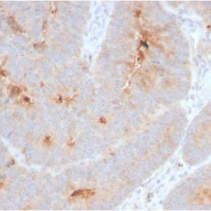 Formalin-fixed, paraffin-embedded human Colon Carcinoma stained with Secretory Component Rabbit Recombinant Monoclonal (ECM1/2889R).
