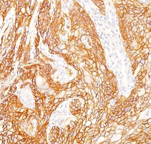 Formalin-fixed, paraffin-embedded human lung SqCC stained with EGFR Mouse Monoclonal Antibody (GFR/2341).