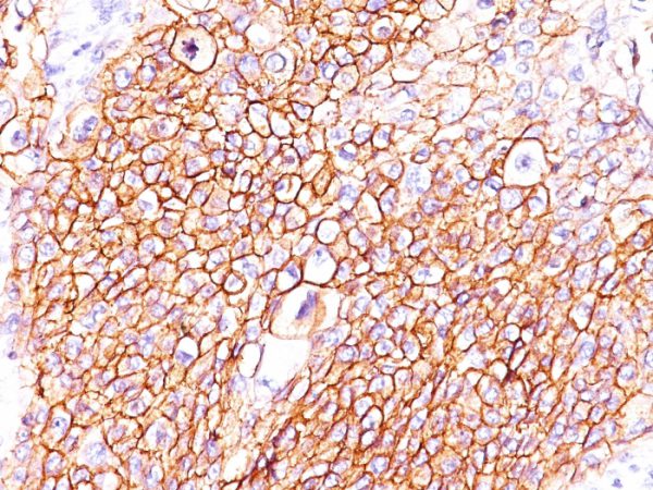Formalin-fixed, paraffin-embedded human lung SqCC stained with EGFR Mouse Monoclonal Antibody (GFR/2596).