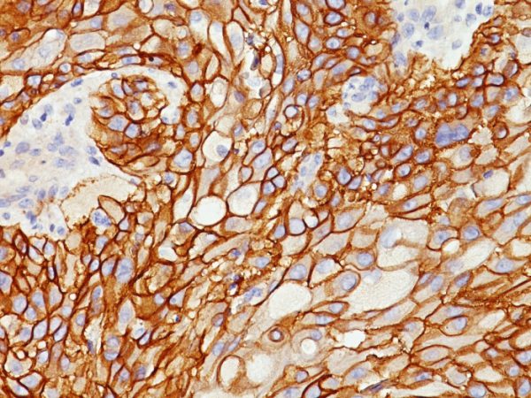 Formalin-fixed, paraffin-embedded human Lung SCC stained with EGFR Mouse Monoclonal Antibody (GFR/1708).