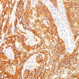 Formalin-fixed, paraffin-embedded human Lung SqCC stained with EGFRvIII Rabbit Recombinant Monoclonal Antibody (GFR/2600R).