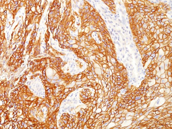 Formalin-fixed, paraffin-embedded human Lung SqCC stained with EGFRvIII Rabbit Recombinant Monoclonal Antibody (GFR/2600R).