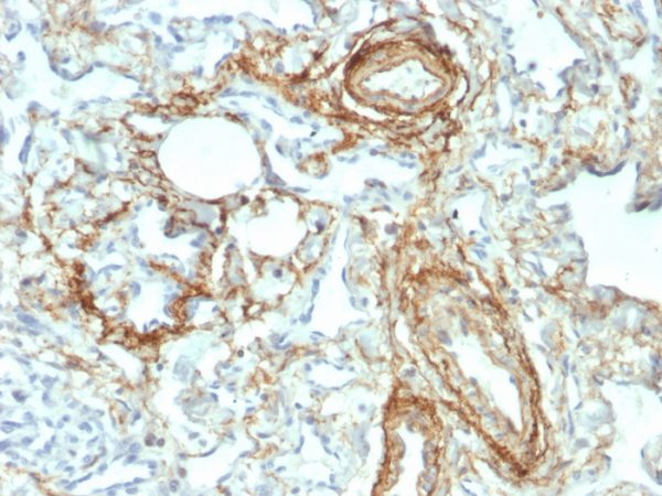 Formalin-fixed, paraffin-embedded human Angiosarcoma stained with Elastin Mouse Monoclonal Antibody (ELN/2069).