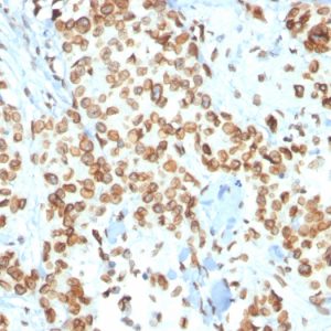 Formalin-fixed, paraffin-embedded human Breast Carcinoma stained with Emerin Mouse Monoclonal Antibody (EMD/2167).