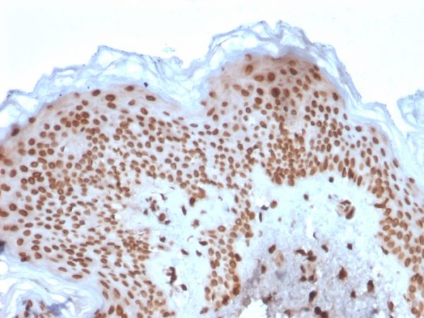 Formalin-fixed, paraffin-embedded human Basal Cell Carcinoma stained with Emerin Mouse Monoclonal Antibody (EMD/2167).