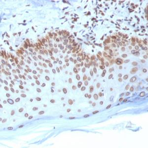 Formalin-fixed, paraffin-embedded human Breast Carcinoma stained with Emerin Mouse Monoclonal Antibody (EMD/2168).