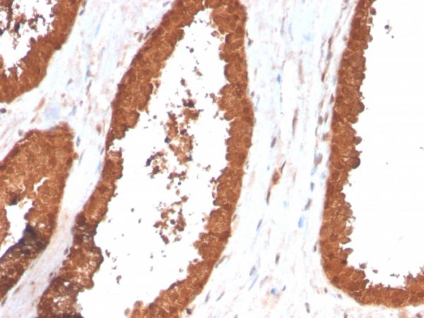 Formalin-fixed, paraffin-embedded human Prostate Carcinoma stained with TIGIT-Monospecific Mouse Monoclonal Antibody (TIGIT/3017).