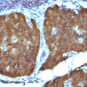 Formalin-fixed, paraffin-embedded human Pheochromocytoma stained with NSE gamma Mouse Monoclonal Antibody (ENO2/1462).