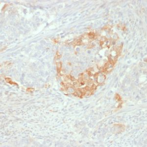 Formalin-fixed, paraffin-embedded human Neuroendocrine tumor stained with NSE gamma Mouse Monoclonal Antibody (NSE-P2).