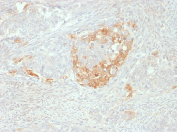 Formalin-fixed, paraffin-embedded human Neuroendocrine tumor stained with NSE gamma Mouse Monoclonal Antibody (NSE-P2).