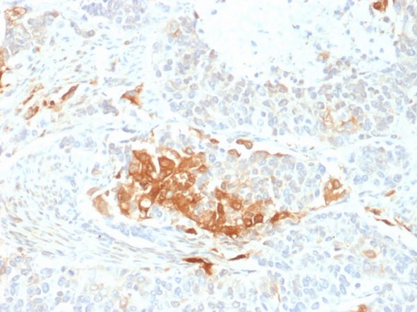Formalin-fixed, paraffin-embedded human neuroendocrine tumor stained with NSE gamma Mouse Monoclonal Antibody (ENO2/2706).