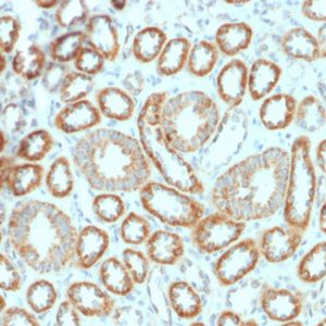 Formalin-fixed, paraffin-embedded human Renal Cell Carcinoma stained with Erythropoietin (EPO) Mouse Monoclonal Antibody (EPO/1367).