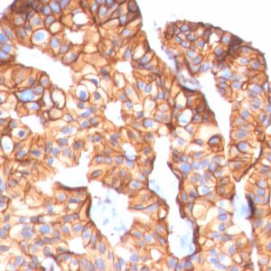 Formalin-fixed, paraffin-embedded human Breast Carcinoma stained with HER-2 Mouse Monoclonal Antibody (ERBB2/2452).