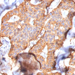 Formalin-fixed, paraffin-embedded human Breast Carcinoma stained with HER-2 Mouse Monoclonal Antibody (SPM172).