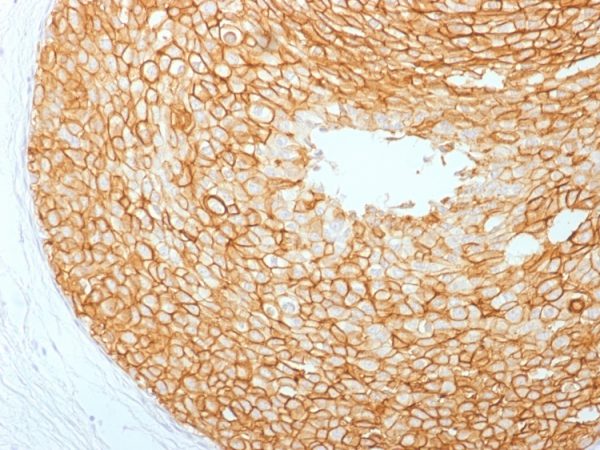 Formalin-fixed, paraffin-embedded human Breast Carcinoma stained with HER-2 Mouse Monoclonal Antibody (ERBB2/2453).