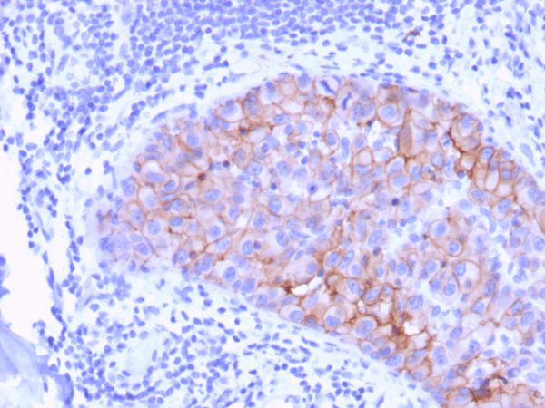 Formalin-fixed, paraffin-embedded human Breast Carcinoma stained with HER-2 Mouse Monoclonal Antibody (ERBB2/3078).