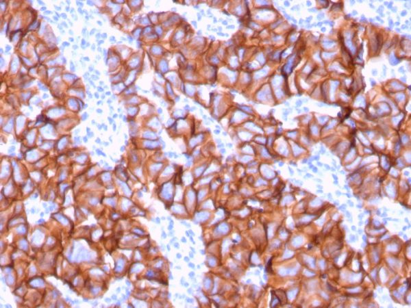 Formalin-fixed, paraffin-embedded human Breast Carcinoma stained with HER-2 Mouse Monoclonal Antibody (ERBB2/3078).