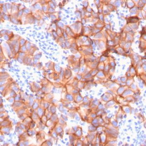 Formalin-fixed, paraffin-embedded human Breast Carcinoma stained with HER-2 Mouse Monoclonal Antibody (ERBB2/3079).