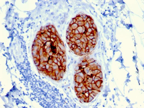 Formalin-fixed, paraffin-embedded human Breast Carcinoma stained with HER-2 Mouse Monoclonal Antibody (ERBB2/3080).
