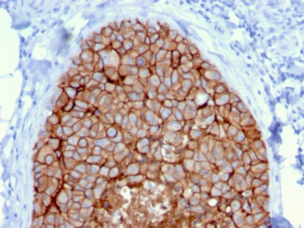 Formalin-fixed, paraffin-embedded human Breast Carcinoma stained with HER-2 Mouse Monoclonal Antibody (ERBB2/3080).