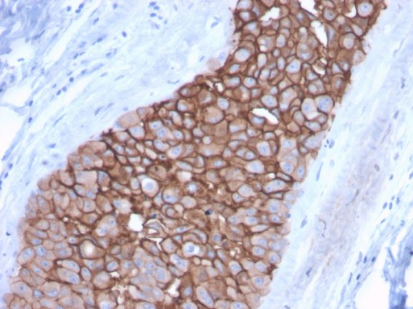 Formalin-fixed, paraffin-embedded human Breast Carcinoma stained with HER-2 Mouse Monoclonal Antibody (ERBB2/3092).