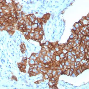 Formalin-fixed, paraffin-embedded human breast carcinoma stained with HER-2 Monospecific Mouse Monoclonal Antibody (ERBB2/3257).