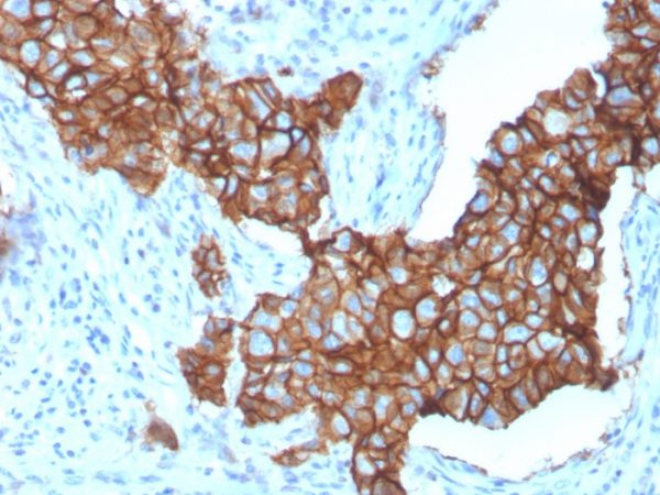 Formalin-fixed, paraffin-embedded human breast carcinoma stained with HER-2 Monospecific Mouse Monoclonal Antibody (ERBB2/3257).