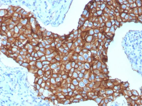Formalin-fixed, paraffin-embedded human breast carcinoma stained with HER-2 Mouse Monospecific Monoclonal Antibody (ERBB2/3257).