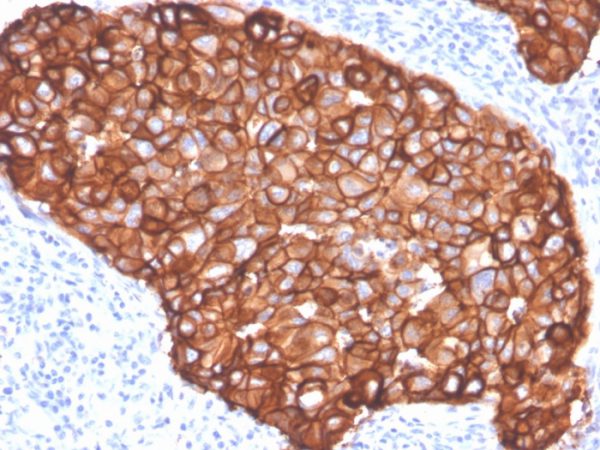 Formalin-fixed, paraffin-embedded human breast carcinoma stained with HER-2 / c-erbB-2 Recombinant Rabbit Monoclonal Antibody (ZR5).