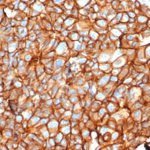 IHC analysis of formalin-fixed, paraffin-embedded human breast carcinoma. Stained using ERBB2/4376R at 2ug/ml in PBS for 30min RT. HIER: Tris/EDTA, pH9.0, 45min. 2°C: HRP-polymer, 30min. DAB, 5min.