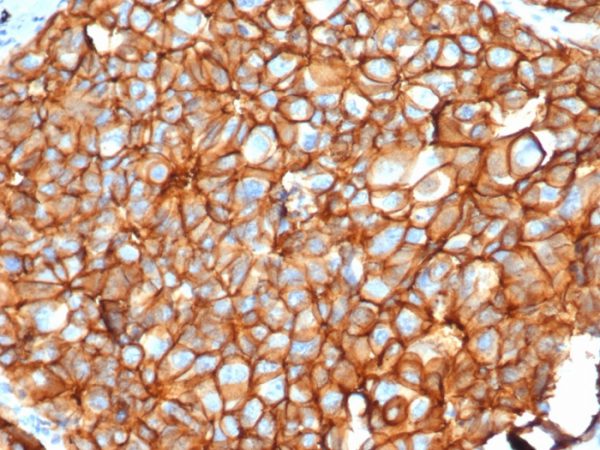 IHC analysis of formalin-fixed, paraffin-embedded human breast carcinoma. Stained using ERBB2/4376R at 2ug/ml in PBS for 30min RT. HIER: Tris/EDTA, pH9.0, 45min. 2°C: HRP-polymer, 30min. DAB, 5min.