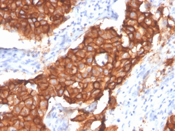 Formalin-fixed, paraffin-embedded human breast carcinoma stained with HER-2 / c-erbB-2 Recombinant Rabbit Monoclonal Antibody (ERBB2/4439R).