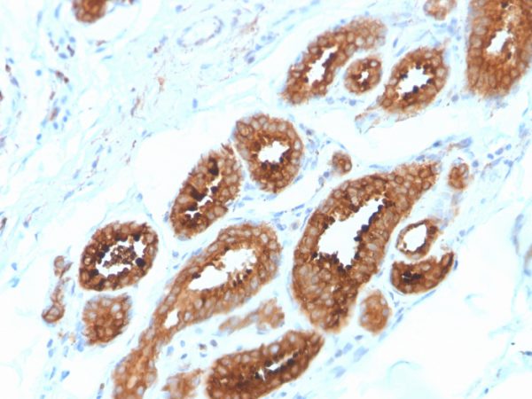 Formalin-fixed, paraffin-embedded human Breast Carcinoma stained with HER-4 / ERBB4 Mouse Monoclonal Antibody (ERBB4/2581).