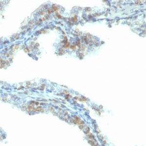 Formalin-fixed, paraffin-embedded human prostate carcinoma stained with ERG Mouse Monoclonal Antibody (ERG/2107).