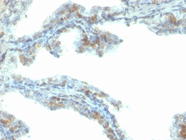 Formalin-fixed, paraffin-embedded human prostate carcinoma stained with ERG Mouse Monoclonal Antibody (ERG/2107).